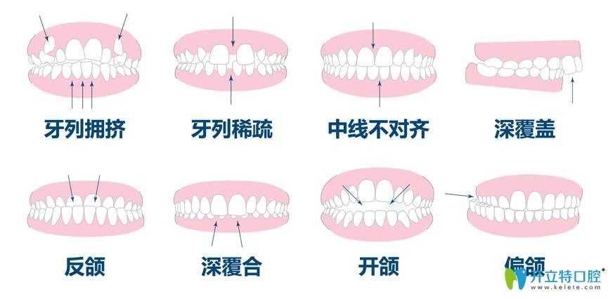 各類牙齒畸形情況