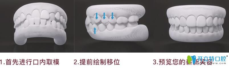 深圳珮斐齒科隱適美隱形矯正流程圖