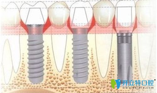 楊高醫(yī)生科普全口無(wú)牙頜種植固定修復(fù)