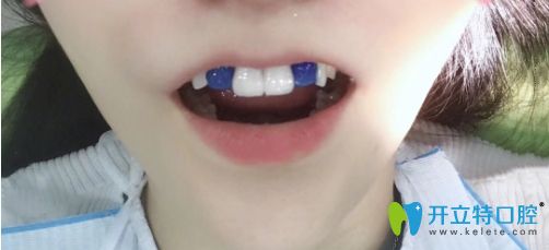 說一說我廣州曙光口腔做完3D數(shù)字全瓷牙貼面的感受及價格