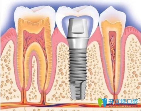 楊高非常擅長(zhǎng)各類(lèi)種植牙技術(shù)