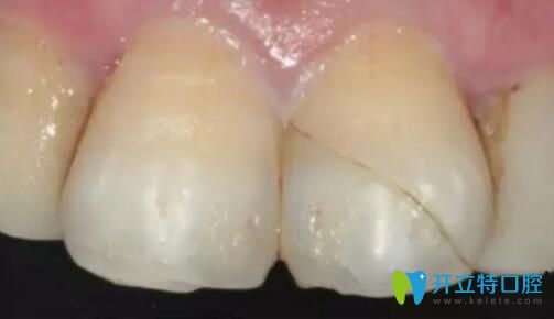 牙齒磕掉自體斷冠再接