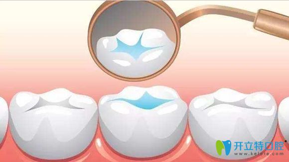 兒童窩溝封閉效果展示圖