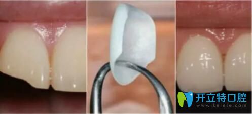 門牙掉了一塊修補(bǔ)后圖