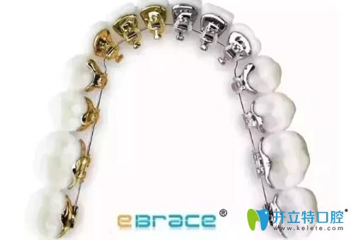 干貨:ebrace舌側(cè)矯正是自鎖的嗎,矯正痛嗎,附ebrace牙套價(jià)格