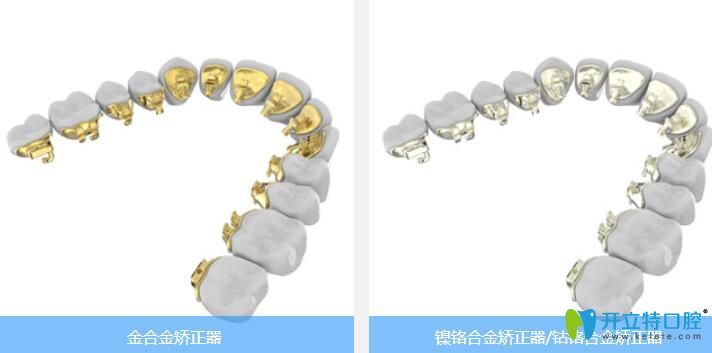 ebrace舌側牙套材質