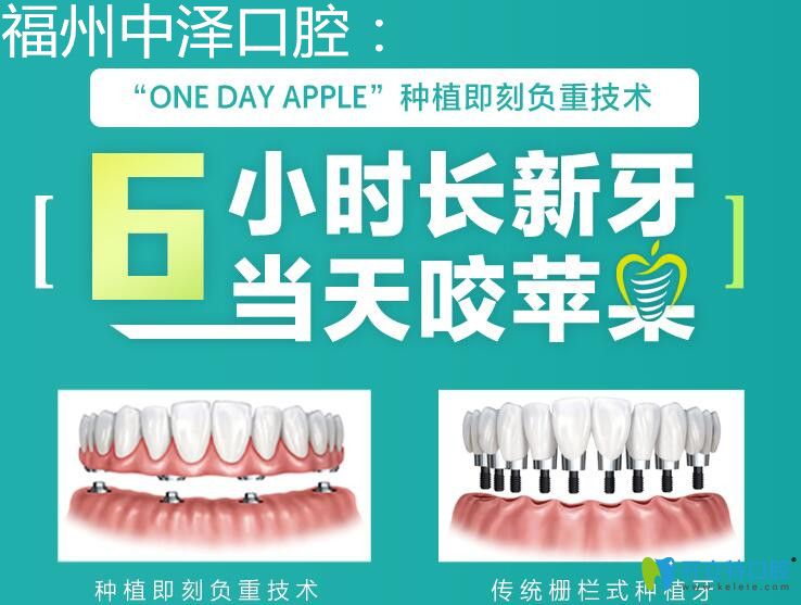 福州中澤口腔即刻負重種植牙技術(shù)
