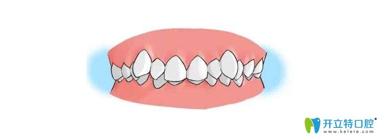 牙列擁擠圖