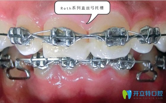 Roth系列直絲弓托槽