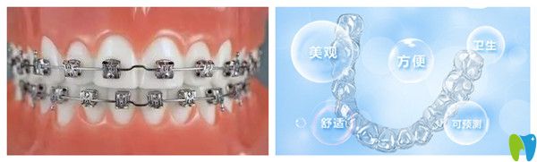 傳統(tǒng)矯正和隱形矯正對(duì)比圖
