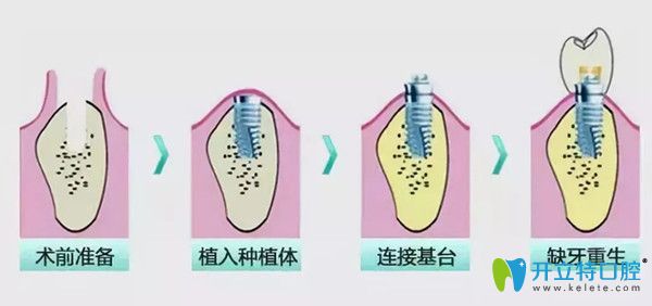 深圳德貝美種植牙怎么樣？從種植牙費(fèi)用及特色技術(shù)分析