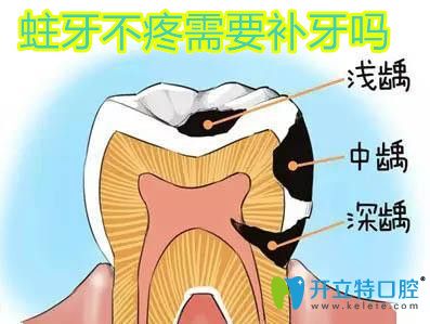 主要不疼不補牙可以嗎