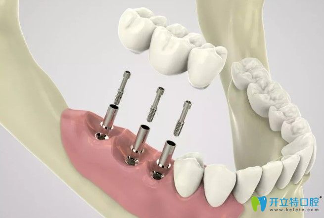 李奇?zhèn)メt(yī)生告訴你怎么延長(zhǎng)種植牙壽命
