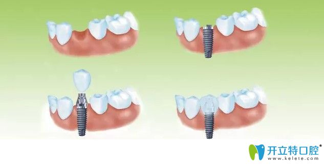 醫(yī)生技術水平不到位會導致種植牙失敗