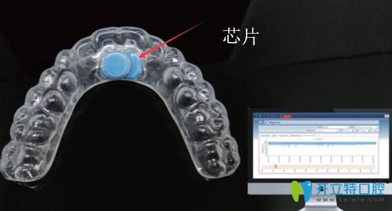 易而戴牙套芯片設計
