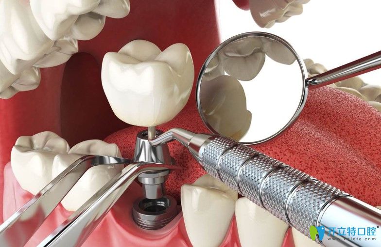 種植牙3年就壞了的原因