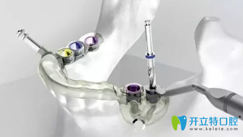 數(shù)字化導板技術種植牙示意圖