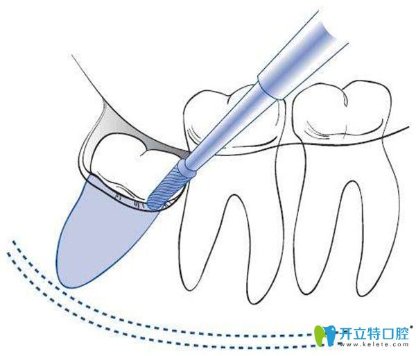 微創(chuàng)拔牙過程