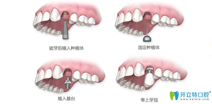 東莞好佰年口腔即刻種植牙圖解