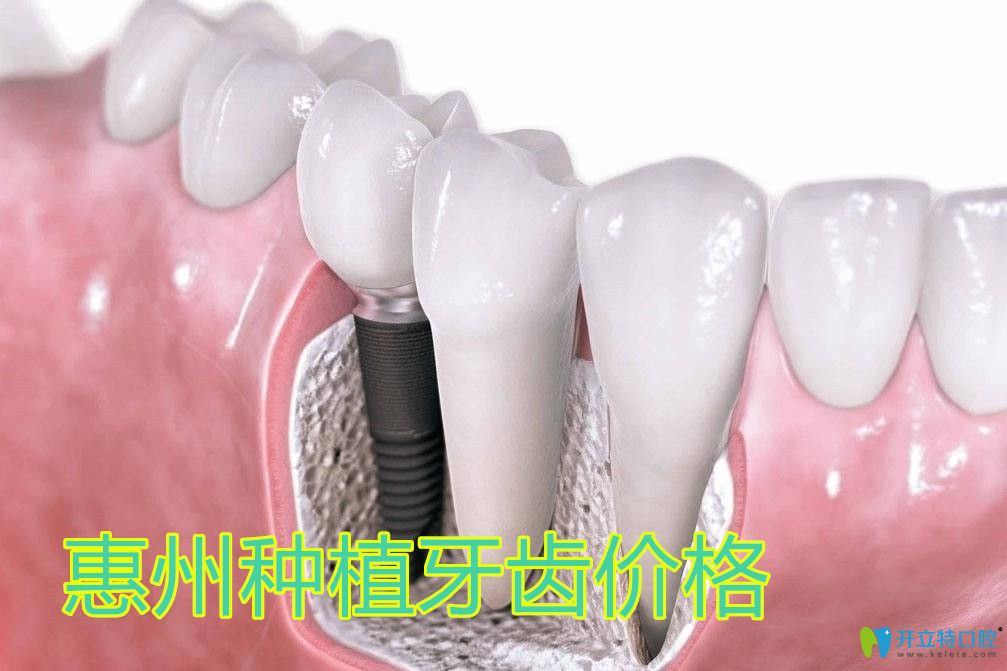 惠州種牙費(fèi)用