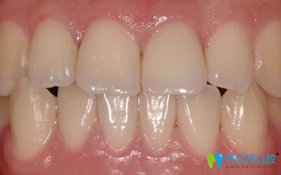 經過牙齦移植手術后健康正常的牙齦圖