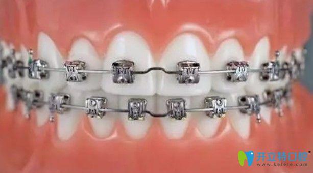 美奧與damon牙套哪個矯正效果好