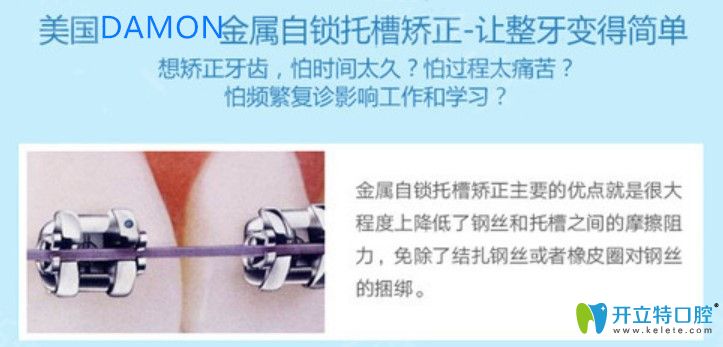 美國damon自鎖托槽矯正優(yōu)勢