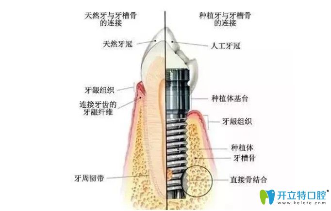 韓國(guó)SG種植牙好不好