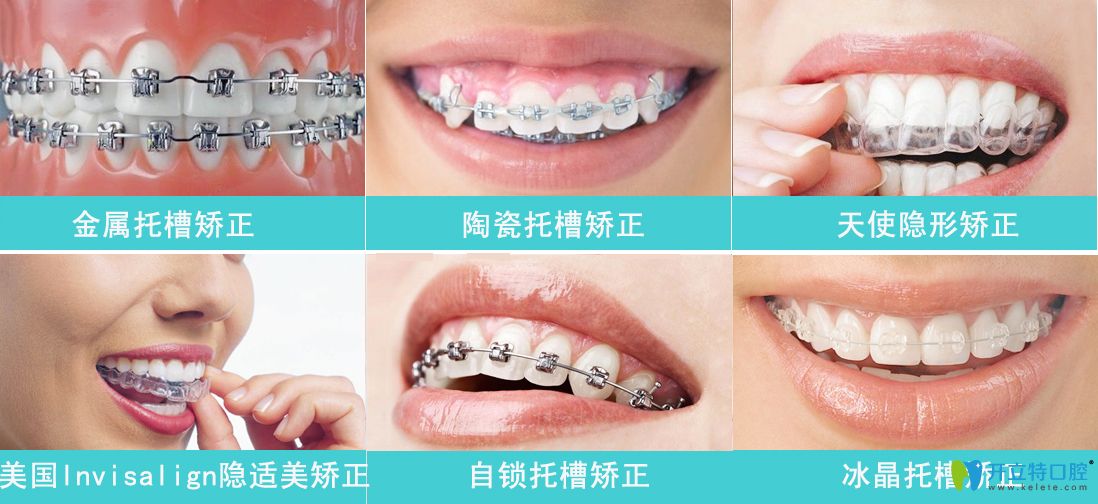 牙齒矯正種類(lèi)