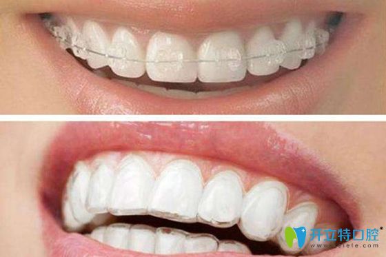 圣貝口腔半隱形牙套和隱形牙套佩戴效果圖