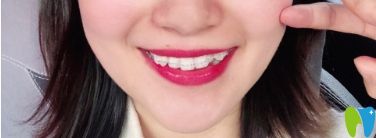 正在戴半隱形矯正時的圖片