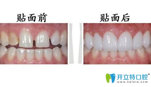 牙齒貼片前后對比