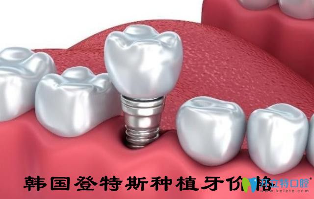 韓國登特斯種植牙價(jià)格