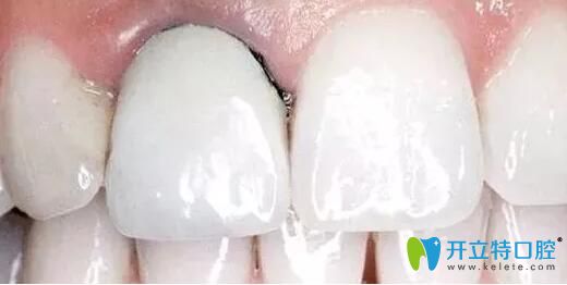 深圳全瓷牙多少錢?參考威蘭德、愛爾創(chuàng)二氧化鋯全瓷牙價格