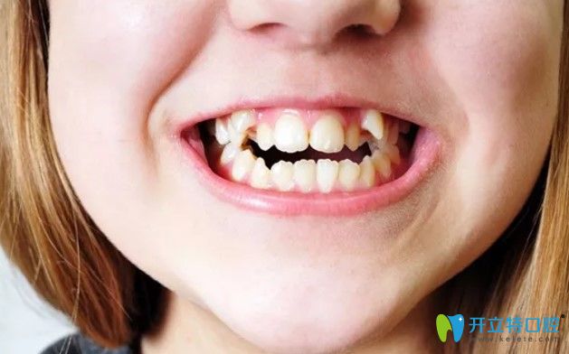畸形牙齒影響口腔的健康