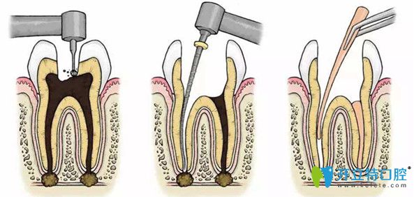 根管治療過程示意圖