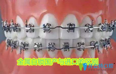 金屬自鎖托槽是國產(chǎn)還是進(jìn)口的好,不妨看看兩個(gè)牙套的區(qū)別