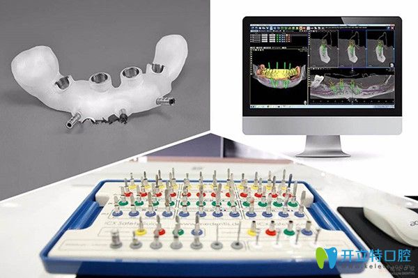 3D導(dǎo)板種植牙