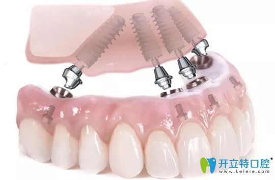 無錫北極星All-on-4半口種植技術 無錫北極星All-on-4半口種植技術