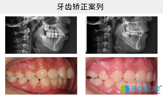 牙齒前突矯正療效圖