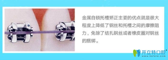 美國AO自鎖托槽矯正圖示