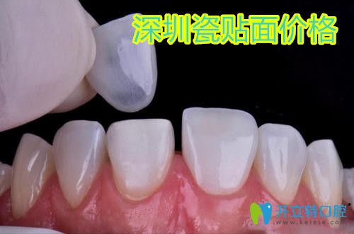 深圳瓷貼面多少錢一顆?請看超薄全瓷貼面品牌排行及價格