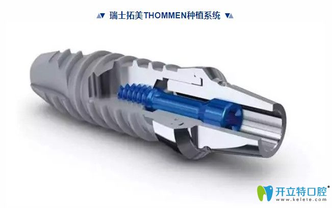 瑞士拓美（thommen）種植體價(jià)格