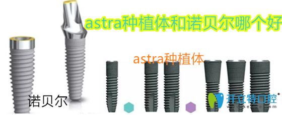 astra種植體和諾貝爾哪個(gè)好