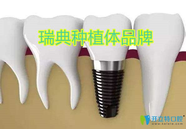 瑞典種植體品牌有哪些,從astra和諾貝爾/Nobel區(qū)別看哪個(gè)好