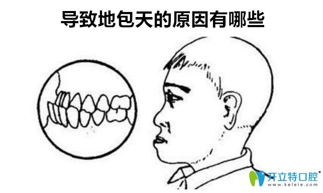導(dǎo)致地包天的原因有哪些