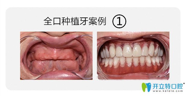 全口種植牙案例圖
