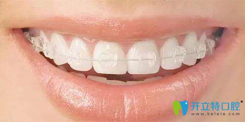 陶瓷自鎖托槽矯正