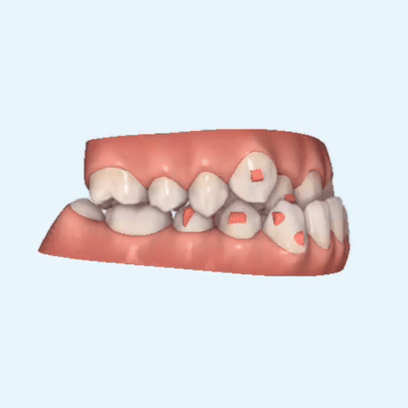 顧客和醫(yī)生都能在屏幕上直觀查看數(shù)據(jù)和觀察牙齒移動(dòng)方向