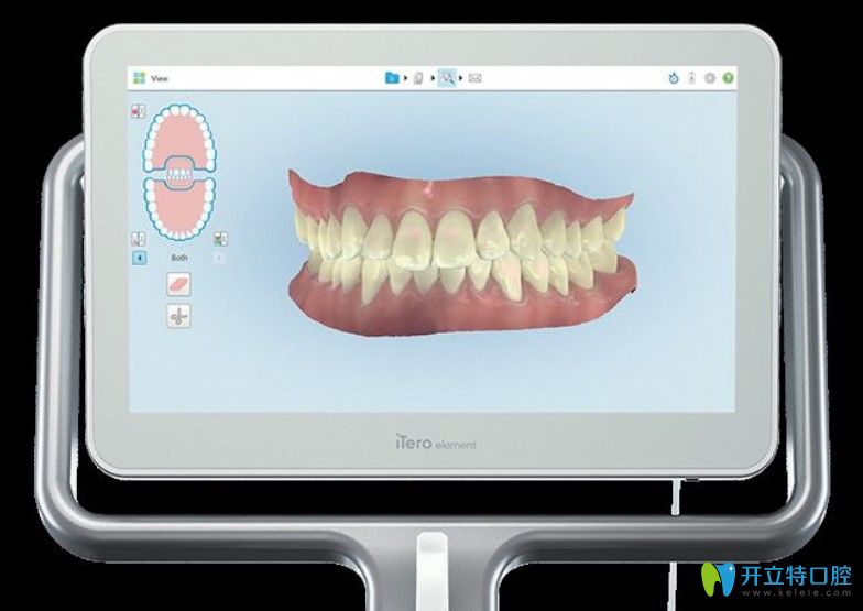 隱適美iTero口和傳統(tǒng)取模相比具體優(yōu)勢(shì)
